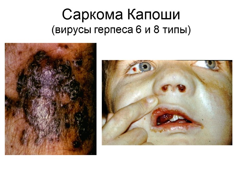 Саркома Капоши  (вирусы герпеса 6 и 8 типы)